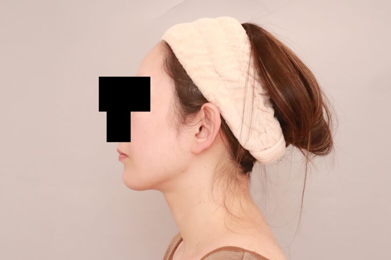 やせ型のモニター様のほほ顎脂肪吸引3か月後♡