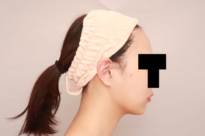 ほほ顎脂肪吸引で女優顔♡3か月後