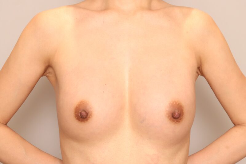 2回豊胸されたママさんモニター様半年後♡