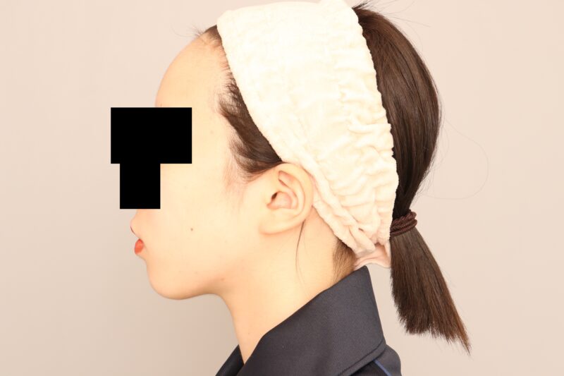 ほほ顎脂肪吸引半年後♡