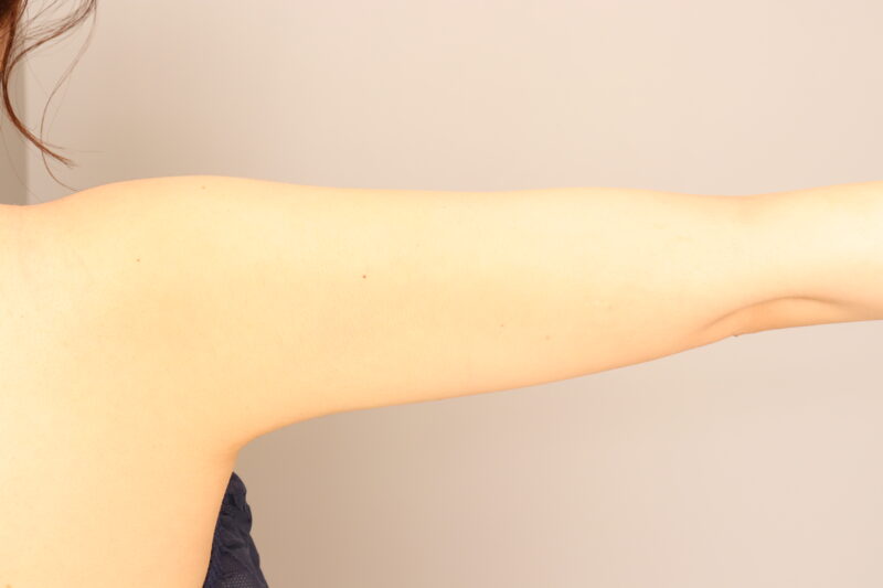 二の腕肩の脂肪吸引3か月後♡