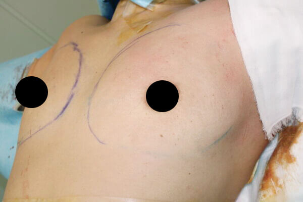 抜去後のバスト