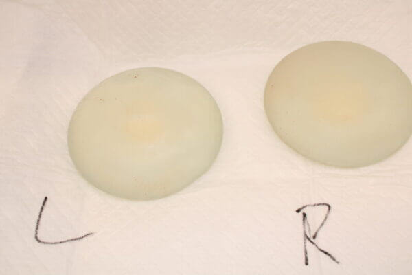 抜去したシリコンバッグ