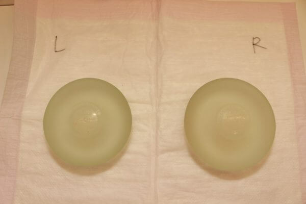 抜去したシリコンバッグ