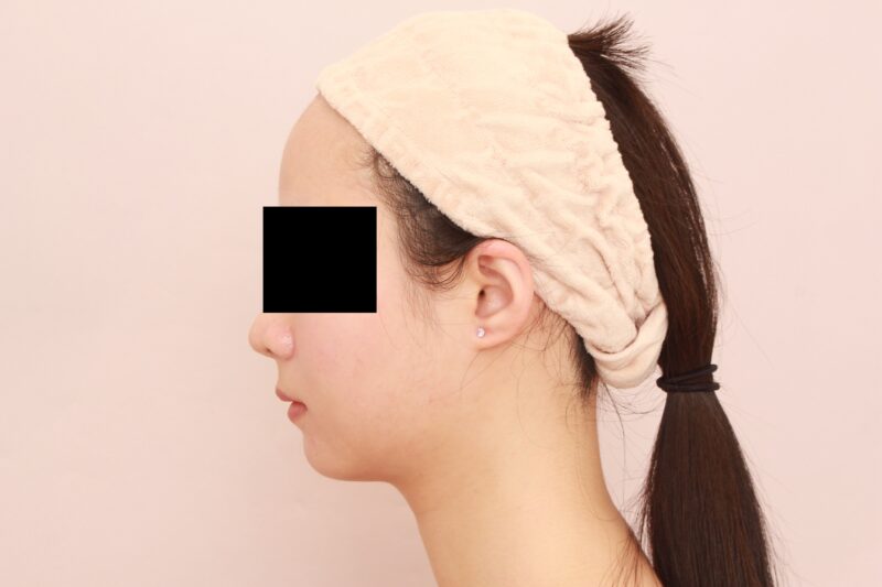 ベイザー脂肪吸引（6カ月経過：29）の術前写真