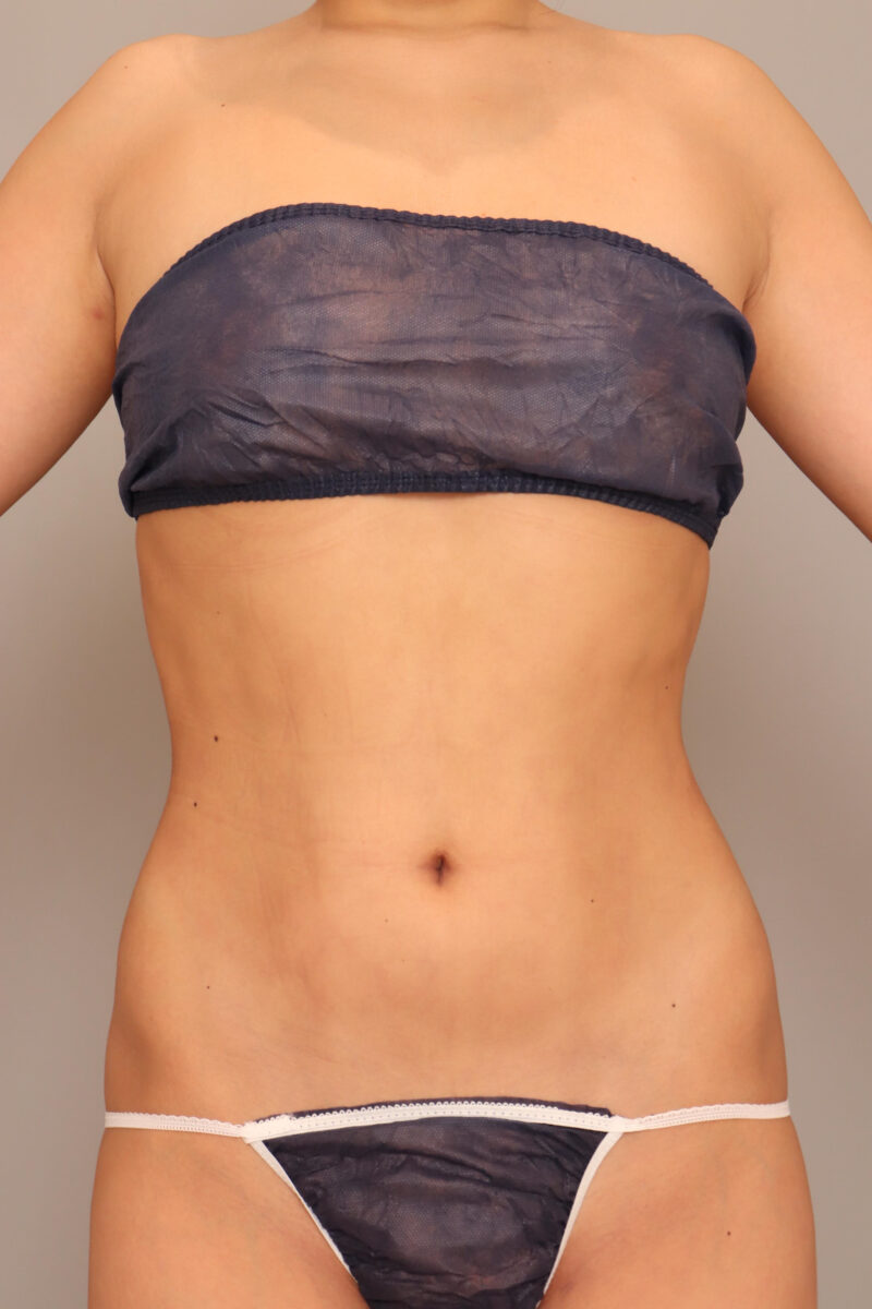 お腹全体胸下腰の脂肪吸引劇的変化な半年後♡