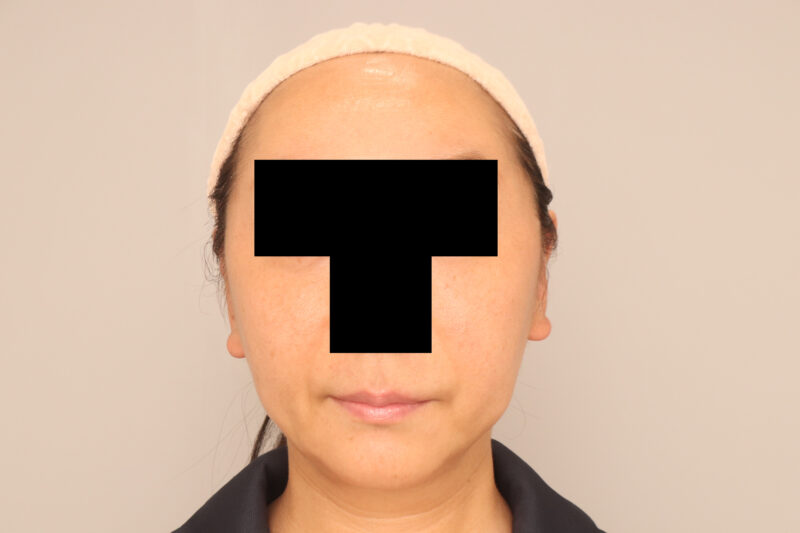 頬顎脂肪吸引の変化半年後