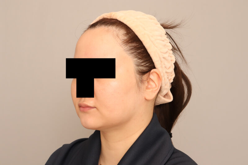 モニター様の頬顎脂肪吸引後の変化