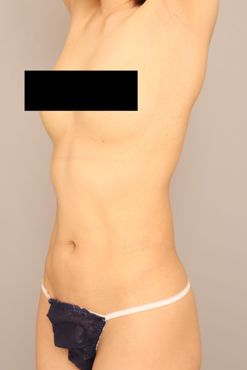 みんなで目指そう峰不二子♡お腹全体胸下腰の脂肪吸引3ヶ月後