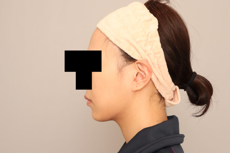 頬顎脂肪吸引半年後♡Vライン顔がお好みの方です