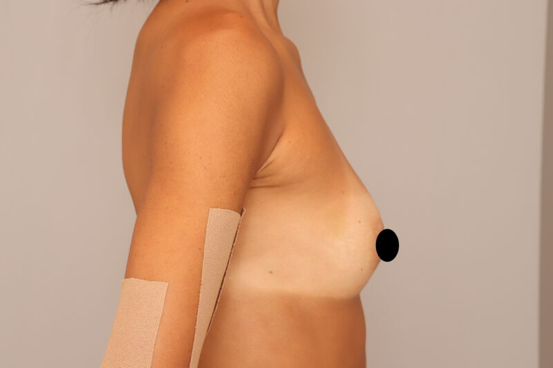 やせ型のモニター様のバスト＆ヒップへのお引越し大作戦②バストの変化