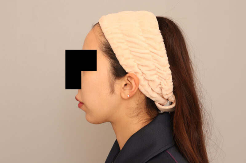 頬顎脂肪吸引のモニター様3ヶ月後♡