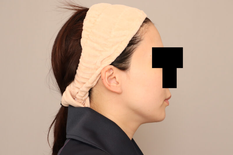 頬顎脂肪吸引でますます美人さんに♡