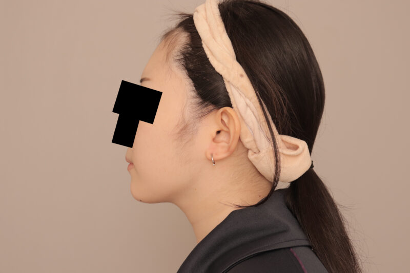 頬顎脂肪吸引のモニター様3ヶ月後