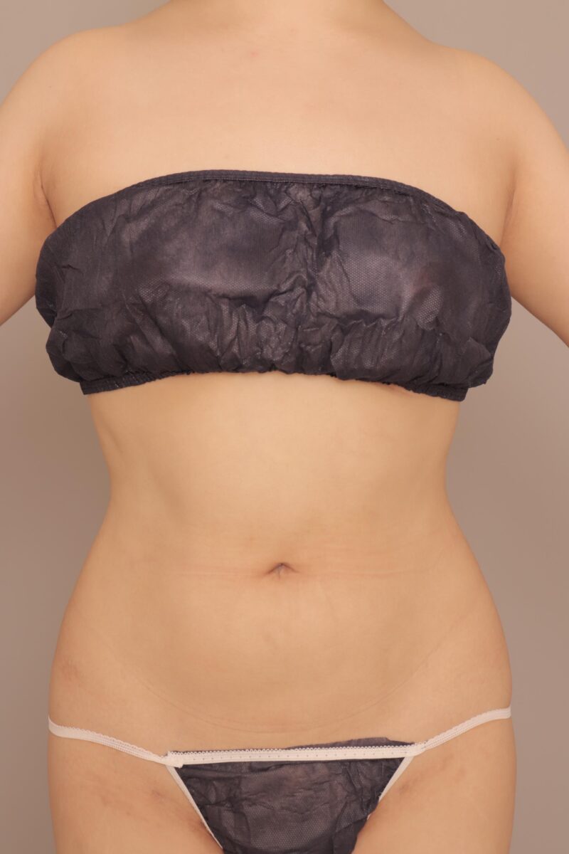 みんなで目指そう峰不二子♪お腹全体胸下腰の脂肪吸引3ヶ月後