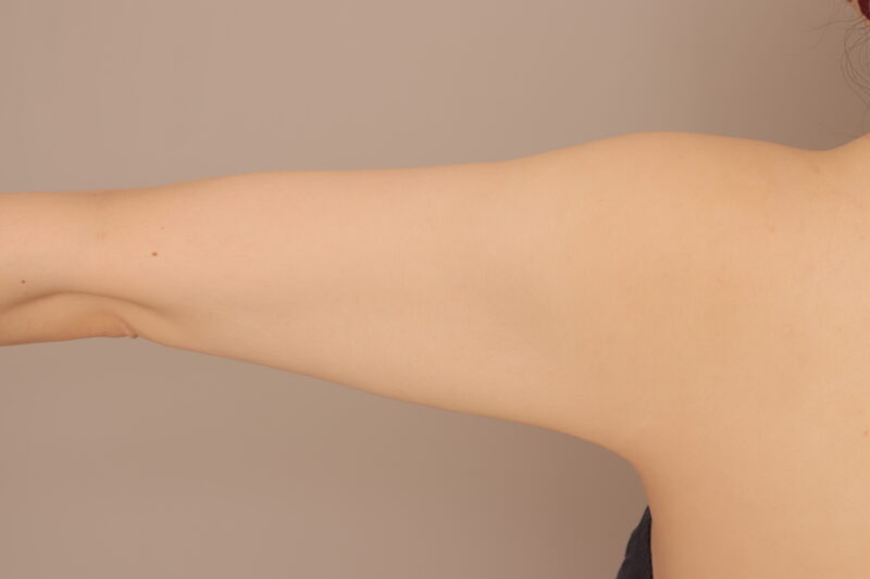 163cm70kg1800cc吸引の二の腕全周の脂肪吸引半年後♪