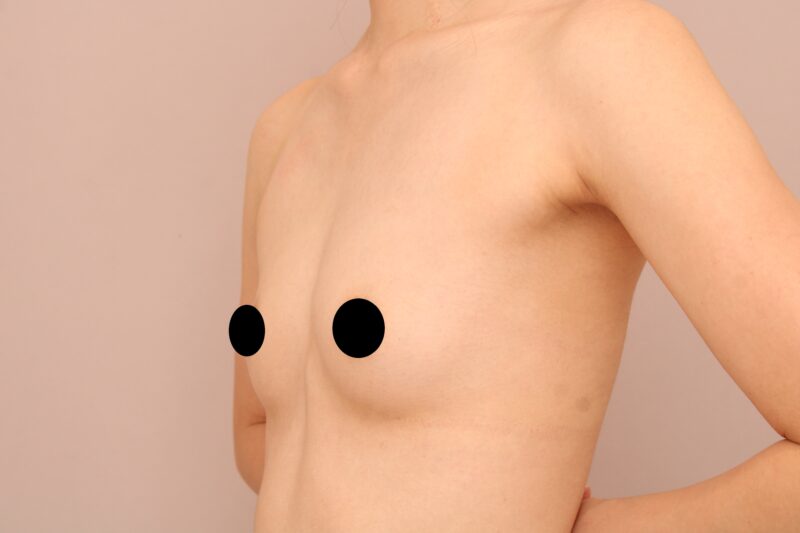 ベイザー脂肪吸引（6ヵ月経過：24）の術前写真