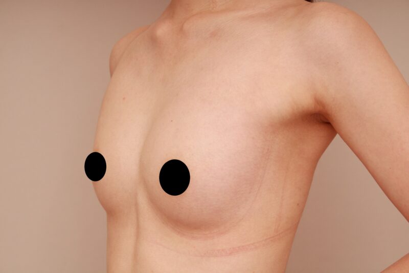 ベイザー脂肪吸引（6ヵ月経過：24）の術後写真