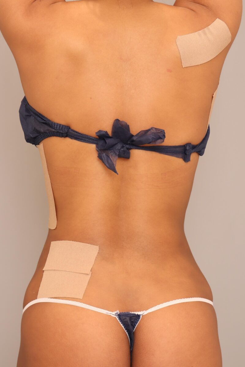 海外の血が入っているミックスのモニター様のお腹全体胸下腰乃脂肪吸引2ヶ月後♪