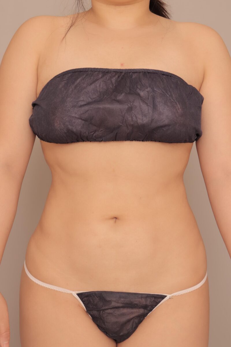 お腹全体胸下腰の脂肪吸引14ヶ月後♡