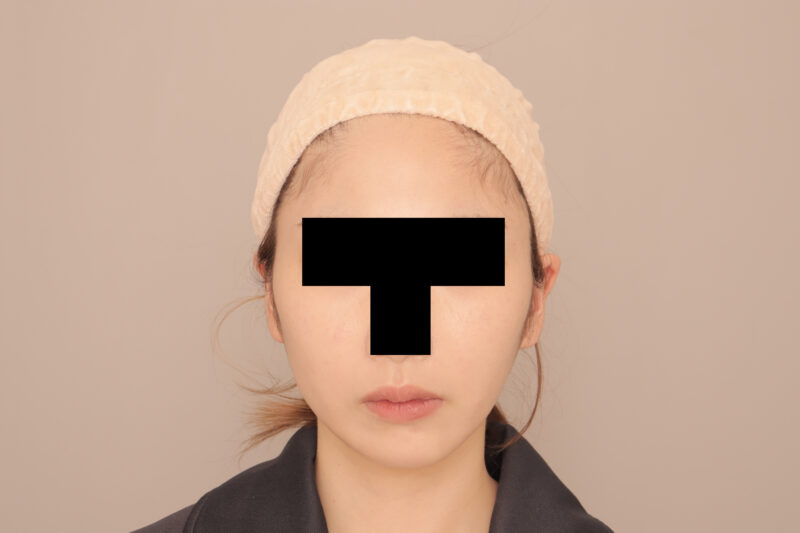 頬顎脂肪吸引1ヶ月後♡シュッとしたフェイスラインに♪