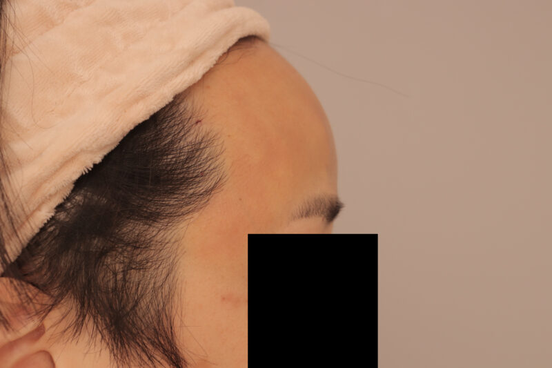 おでここめかみの脂肪注入翌日の様子