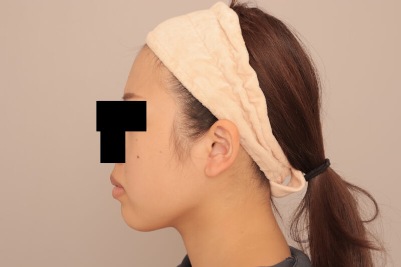 フェイスラインをシュッとさせて目指せ女優顔♡3ヶ月後