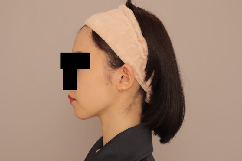 頬顎脂肪吸引で女優顔♪