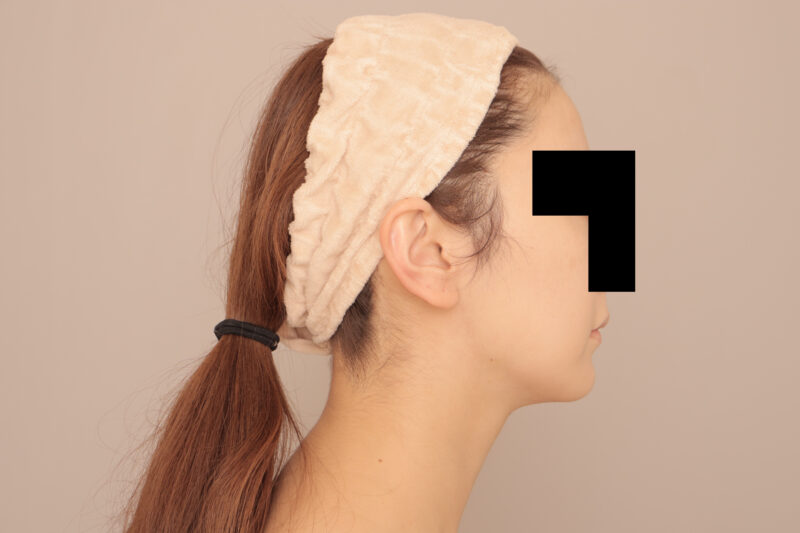 やせ型のモニター様頬顎脂肪吸引半年後♡