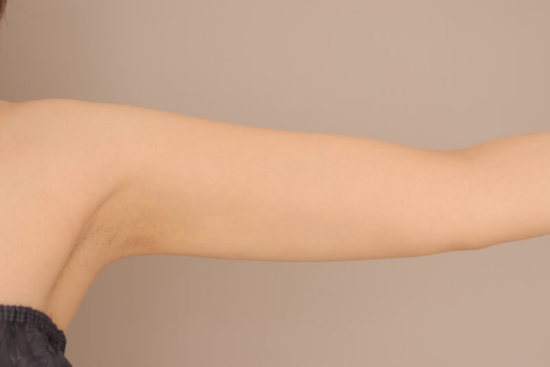 二の腕肩の脂肪吸引半年後♡