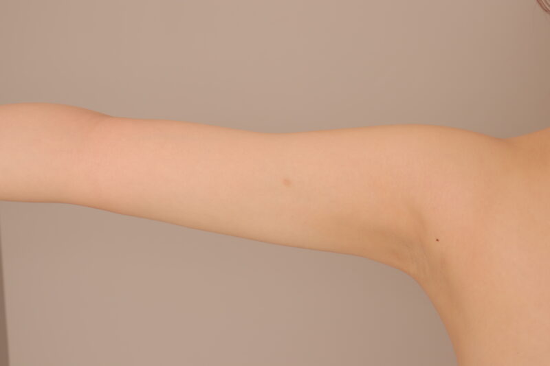 目指せ韓国アイドル系スラッと二の腕3ヶ月後♡