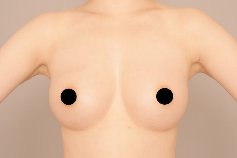 谷間と横乳を作ろう！コンデンスリッチ豊胸でふっくら美バストに♡