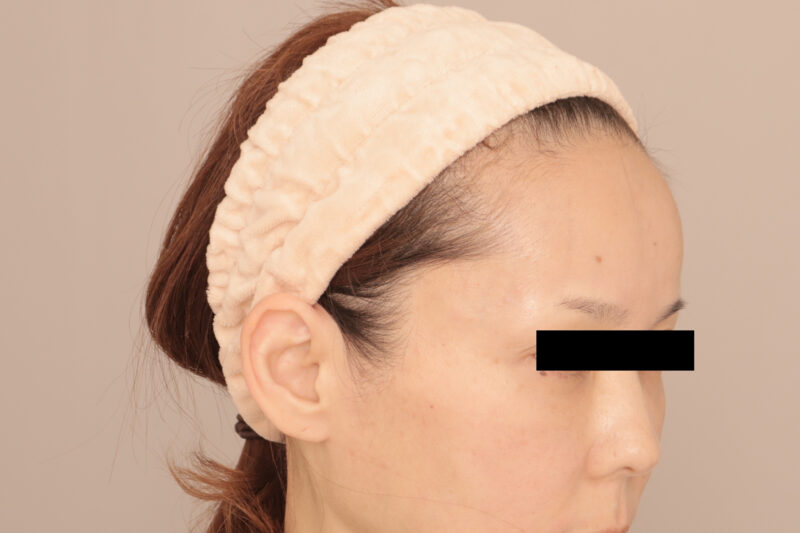 50代のお顔の脂肪注入でエイジングケア♡4ヶ月後♫