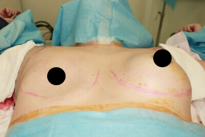 抜去後のバスト