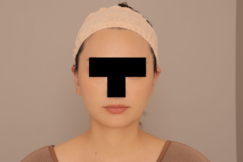 ママさんのマミーメイクオーバー♡頬顎脂肪吸引半年後