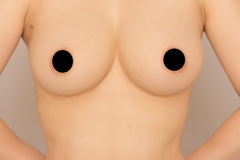 上半身は華奢に♡バストはふっくら♫モニター様9ヶ月後