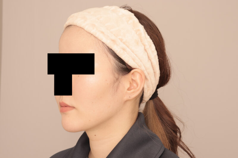 頬顎脂肪吸引で目指せ女優さんのようなフェイスライン♡半年後