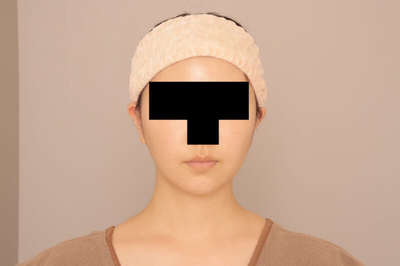 頬顎の脂肪吸引半年後♡