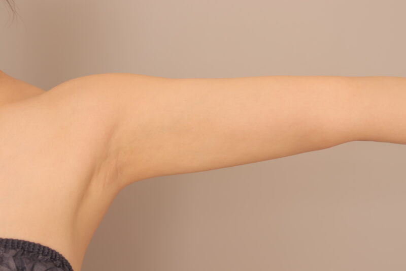 二の腕、肩の脂肪吸引半年後♡