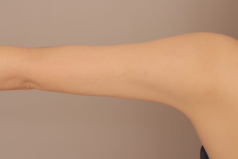 二の腕全周の脂肪吸引モニター様半年後♡