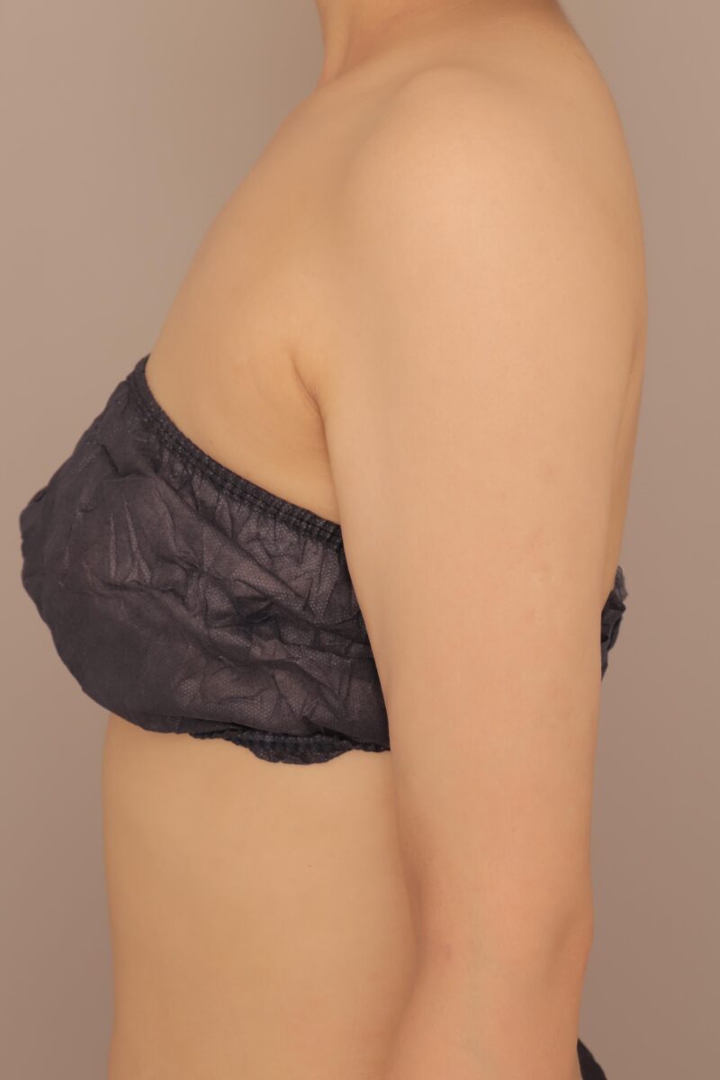 二の腕全周の脂肪吸引半年後♡