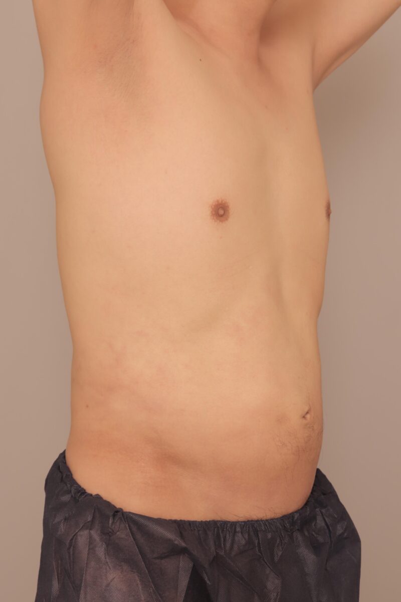メンズの脂肪吸引～44歳  腹部全体胸下腰2300㏄吸引後3ヶ月～