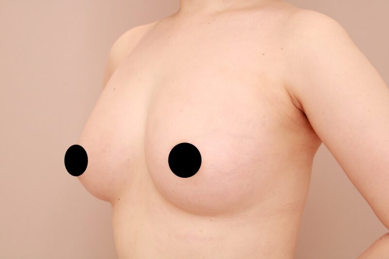 ベイザー脂肪吸引（2回目経過：36）の術後写真