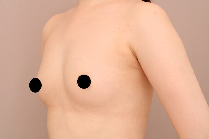 ベイザー脂肪吸引（2回目経過：36）の術前写真