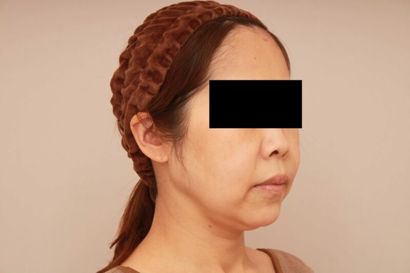【再掲】顔の脂肪吸引に糸リフトは必須か。やらないとたるむ？　46歳女性 頬＋顎下