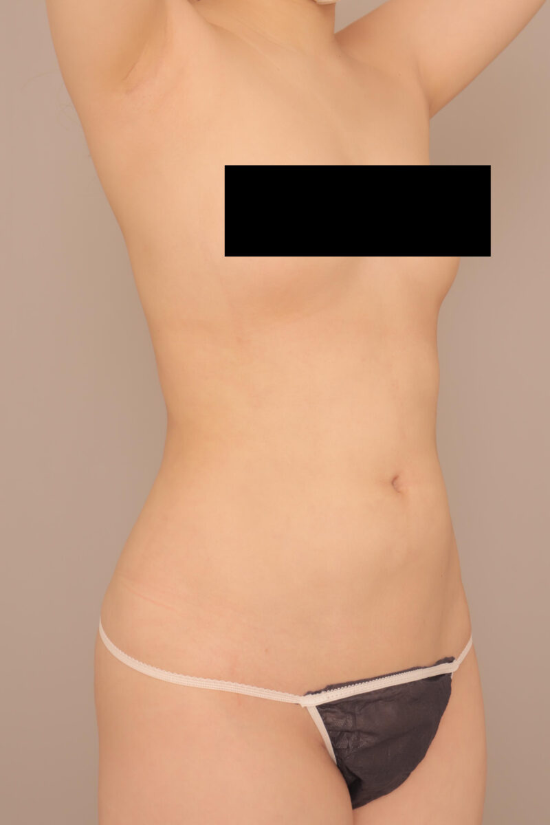 スッキリ!お腹全体胸下腰の脂肪吸引3ヶ月後♡