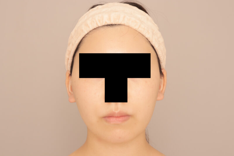 四角い輪郭から逆卵型へ♡モニター様3ヶ月後の変化♫