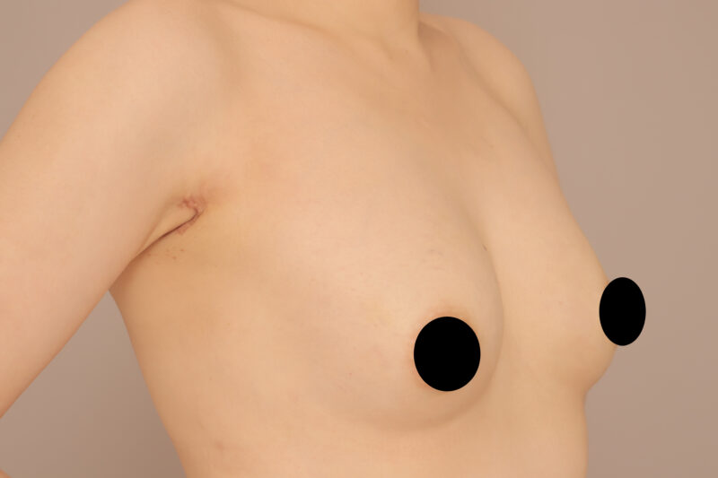 シリコンバックを抜去からのコンデンスリッチ豊胸1ヶ月後♡