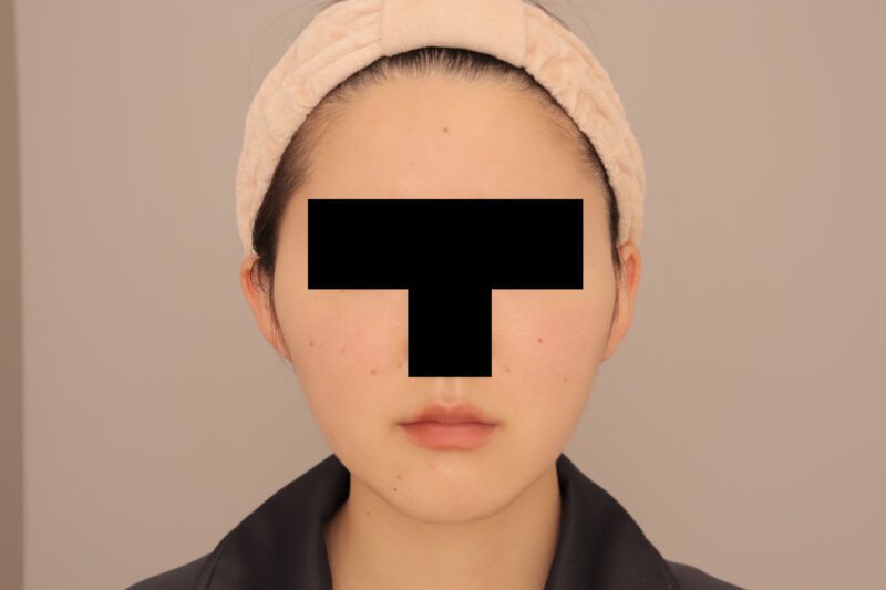 頬顎脂肪吸引3ヶ月後♡逆卵型の輪郭でますます美しく♪