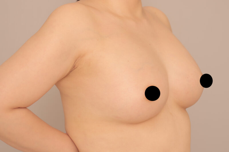 彼氏も喜ぶコンデンスリッチ豊胸のモニター様7ヶ月後の変化♡